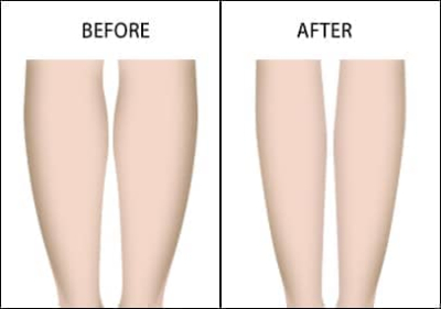 Leg Fat Removal