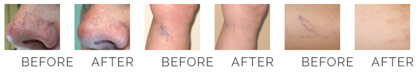 980-diode-laser-vascualr-removal-7