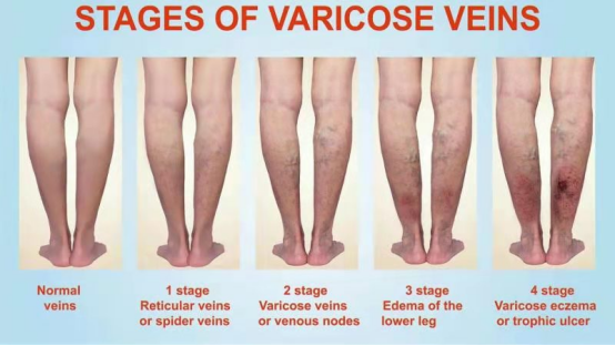 STAGES OF VARICOSE VEINS