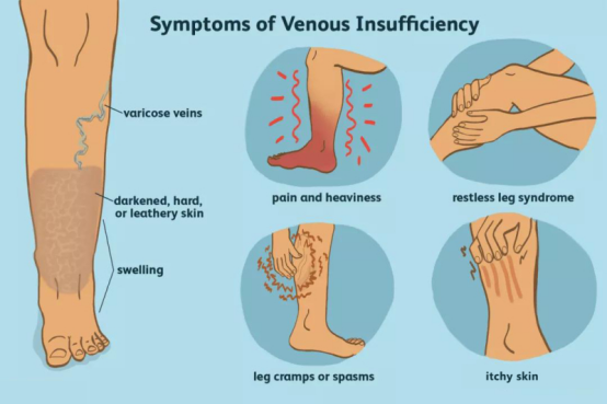Symptoms of Venous Insuffciency