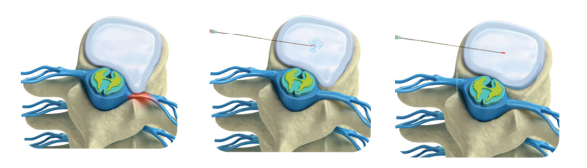 Process PLDD Process PLDD