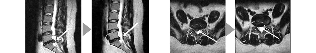 Process PLDD Process PLDD